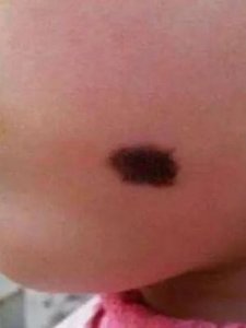 ​胎记的由来(人身上有胎记说明什么)