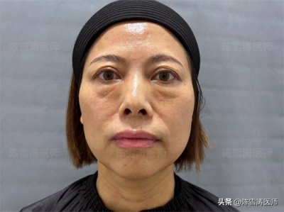 ​48岁眼袋手术失败！修复后成了这样，分享我的真实经历！